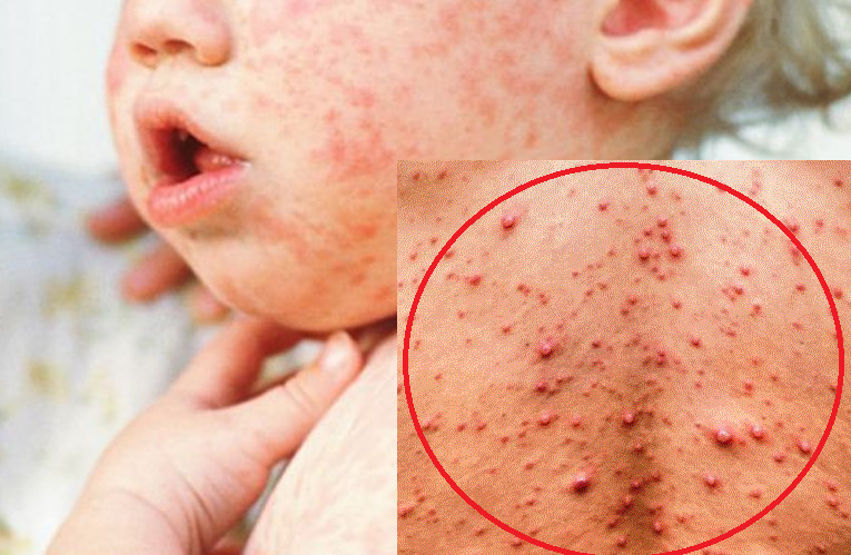 बागलुङको ढोरपाटनमा सात जनामा दादुरा संक्रमण